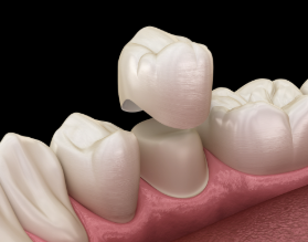 As coroas são moldadas para se assemelhar ao formato e à cor dos dentes naturais, proporcionando um resultado harmonioso e funcional.